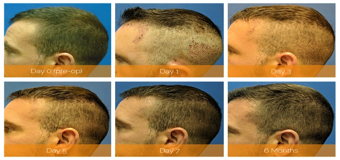 تحتوي هذه الصورة على سمة alt فارغة؛ اسم الملف هو David-hair-transplant-recovery-1.webp